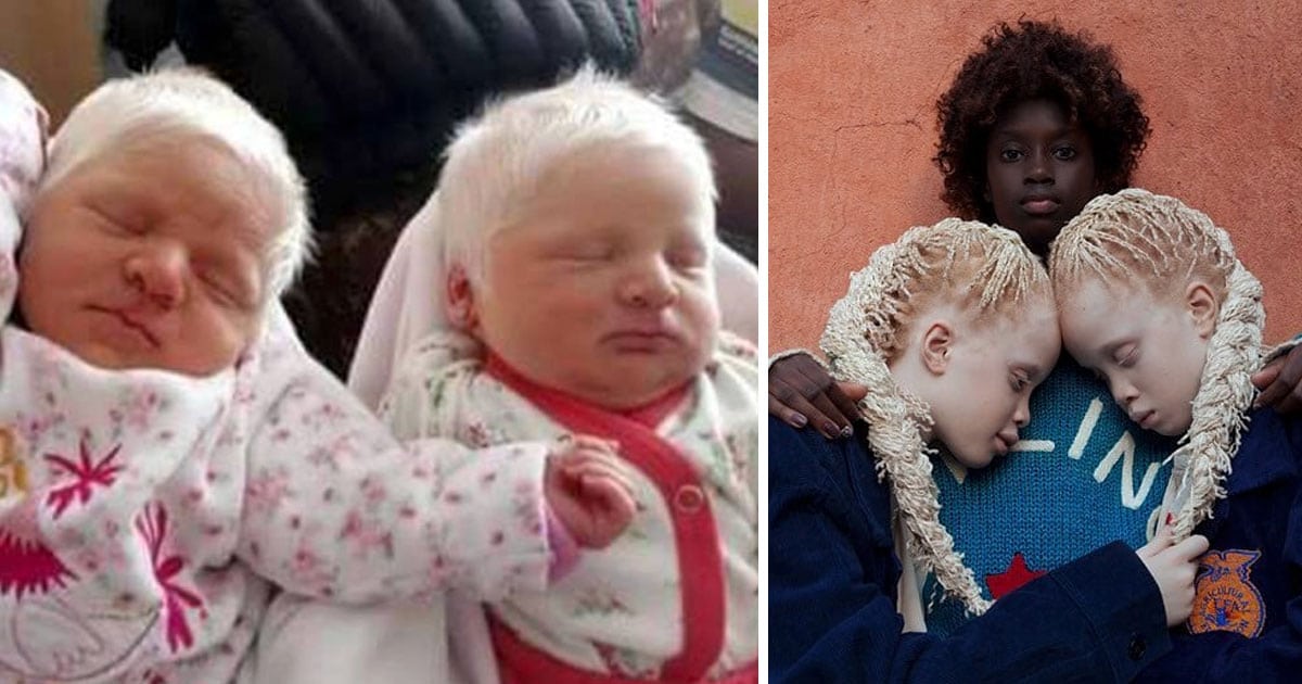 Twins Stun Parents When They Are Born With White Hair